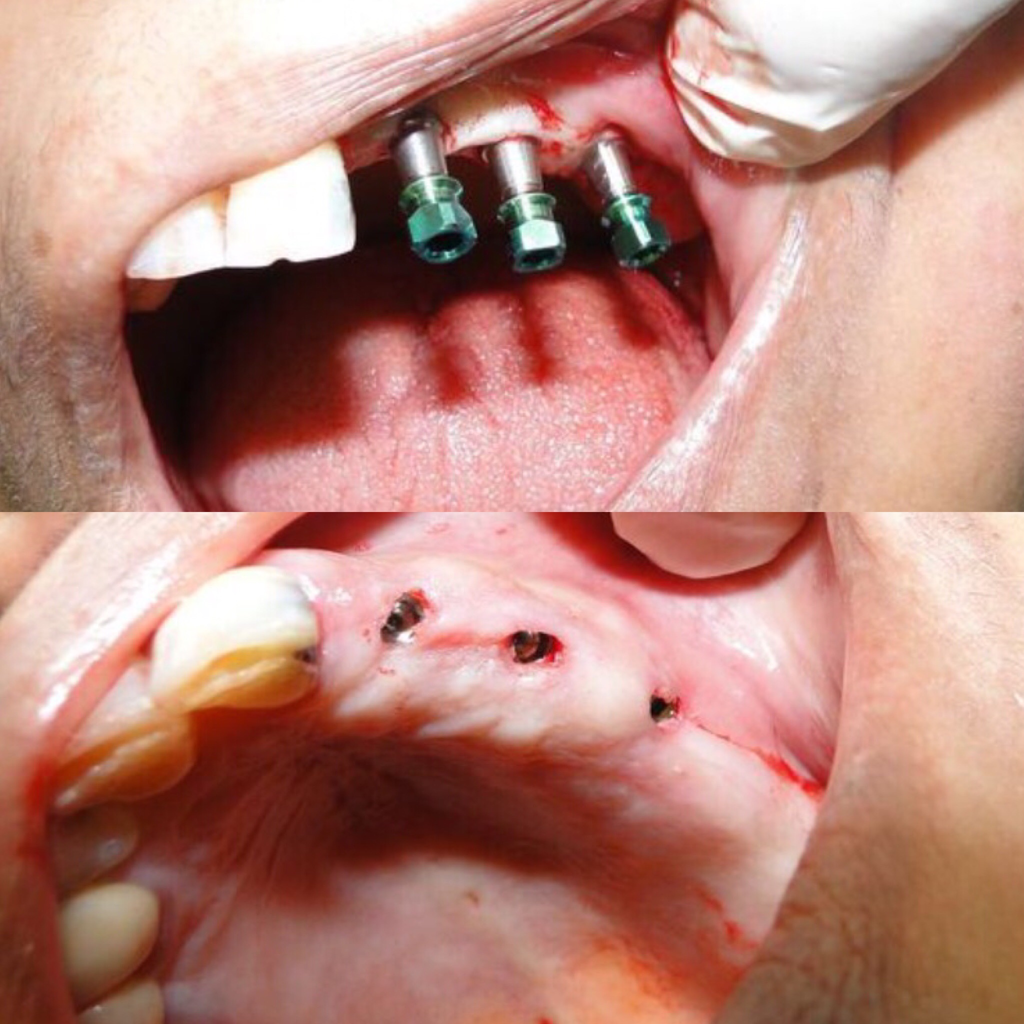 case-3implants